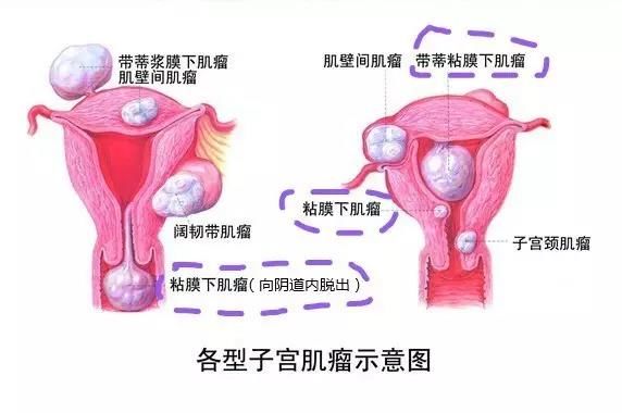 子宫异常出血和大姨妈的区别,判断子宫异常出血最简单的方法