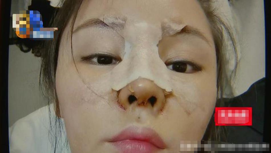 女子*款贷**整容直角鼻，鼻子被做歪，三位对接人员都离职了？