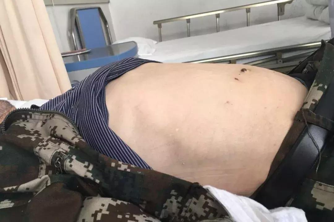 难治性腹水的诊断及治疗,青岛第八人民医院技术怎么样