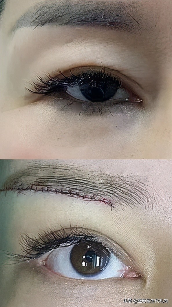 提眉最多一生能做几次提眉,提眉手术怎么操作