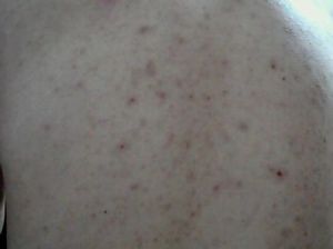 有痘印痘坑黑痘印应该用啥护肤品,脸上痘印太多治疗痘印痘坑的方法