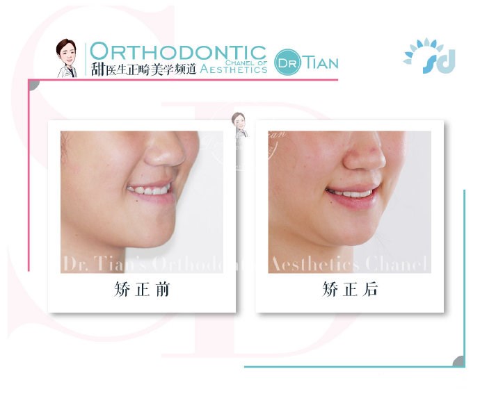 西安哪里有做牙齿矫正,在西安哪里可以做牙齿矫正