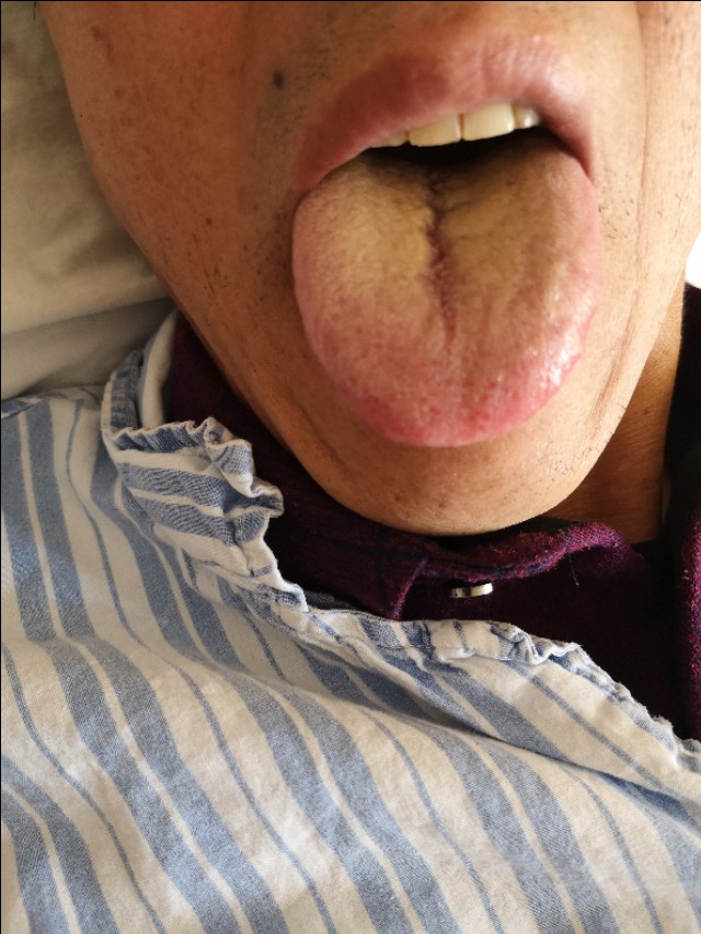 腹部胀满情志焦虑多梦易怒,腹部神经痛焦虑症