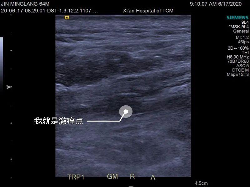 腰痛的可视化针刀治疗,最新治腰疼的针