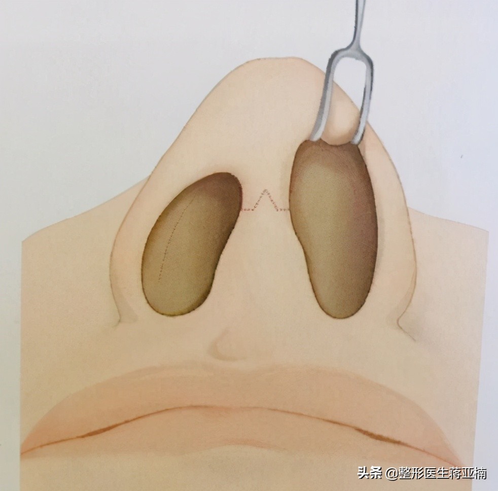 隐藏切口手术,隆鼻手术切口恢复过程