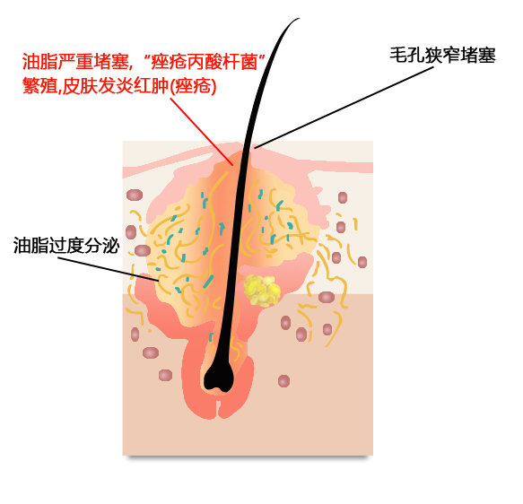 暗疮囊肿为什么要消炎,起脓疮型痘痘用什么药