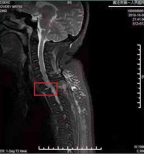 男人截瘫之后怎么解决大小便,男人多年下肢截瘫能生育吗