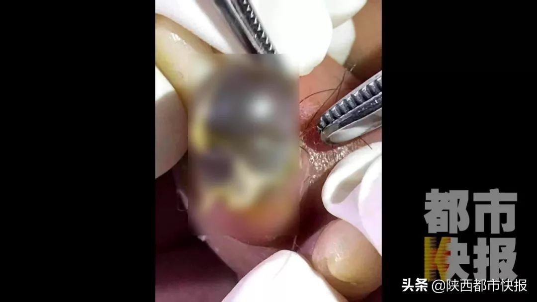 脚趾缺血坏死的原因,脚趾头缺血坏死