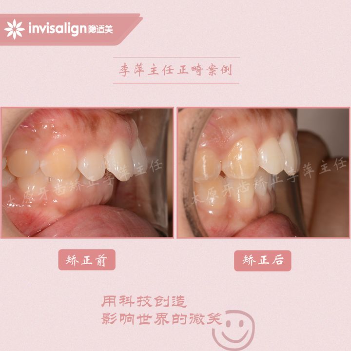 太原矫正牙齿需要做正颌吗,太原牙齿二次矫正