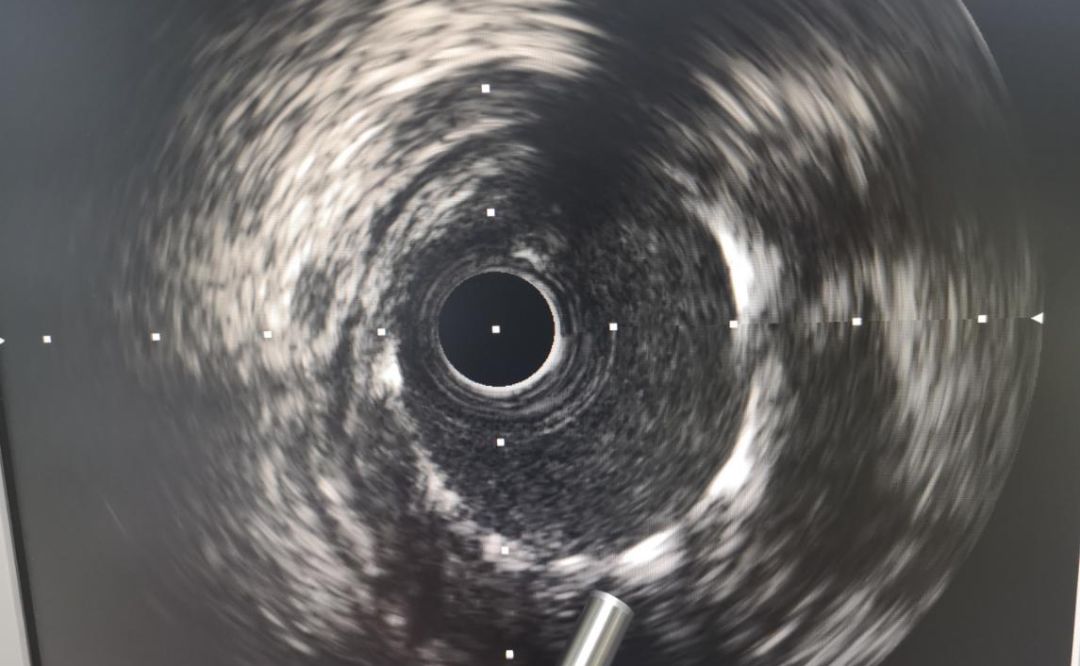 严重急性心肌梗死,抽烟心梗猝死新闻