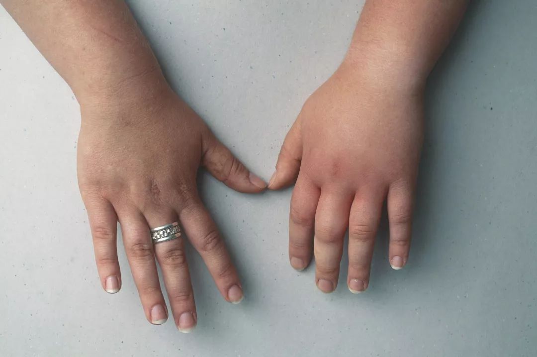 长期身体浮肿要警惕四种病,长期水肿吃什么药有效