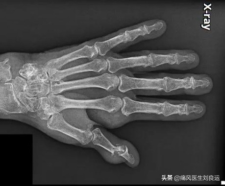 痛风引发腱鞘炎,痛风长出痛风石了怎么办