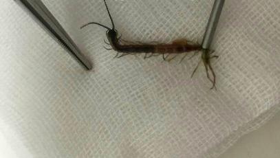 8岁男童在家睡觉耳朵钻进活蟑螂,男童睡觉耳朵钻进活蟑螂全过程