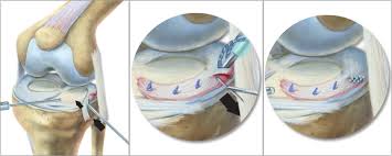 半月板缝合有必要切除滑膜吗,半月板缝合和半月板切除哪个严重