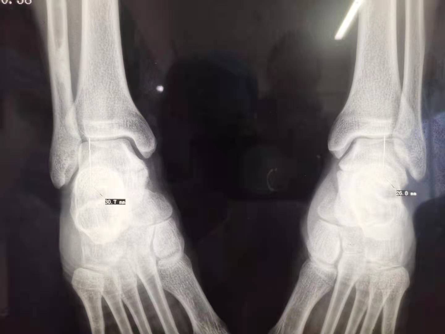 中医正骨手法复位踝关节视频,踝关节脱位中医正骨法