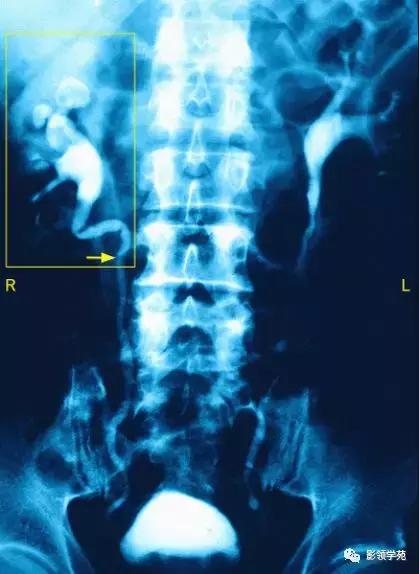 16种常见急性腹痛的诊断与鉴别