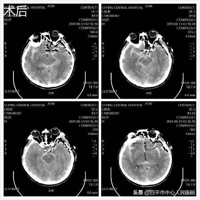 精准排雷再现新高—神经外科在6月份成功救治6例颅内动脉瘤患者