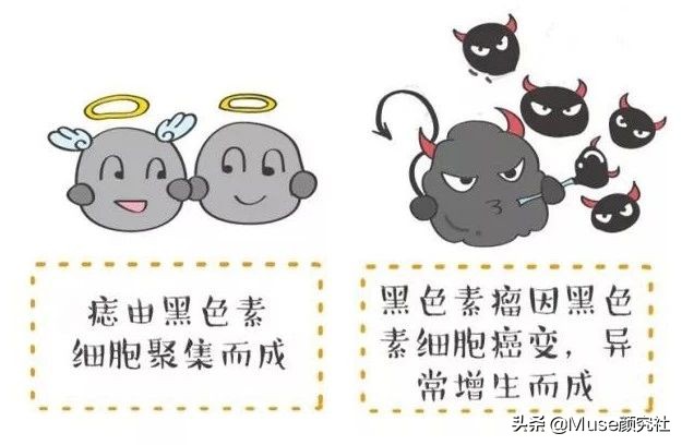 脸上长痦子是有福吗,脸上很容易长痣是什么原因