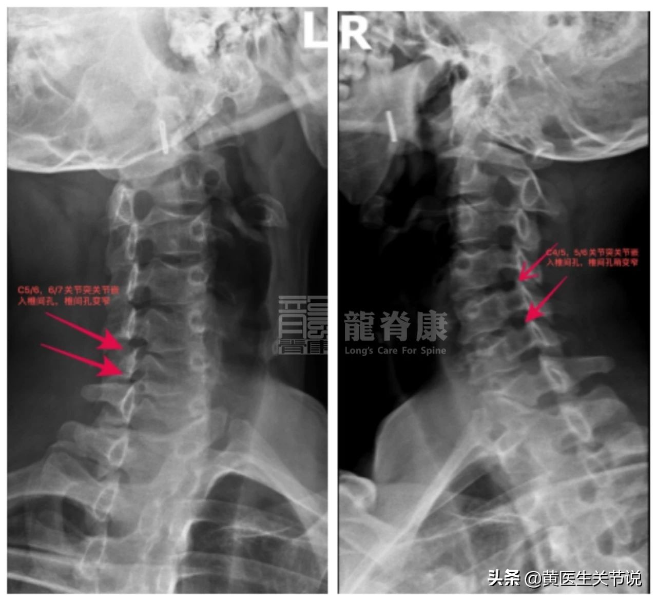 颈椎间盘突出不手术能恢复原位吗,颈椎间盘突出椎管狭窄必须手术吗
