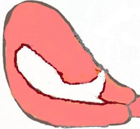 子宫切口憩室二次剖宫产,剖腹产手术十年后子宫内膜异位
