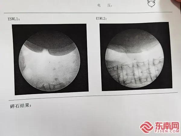 碎石器小型,医用体外碎石机全套设备