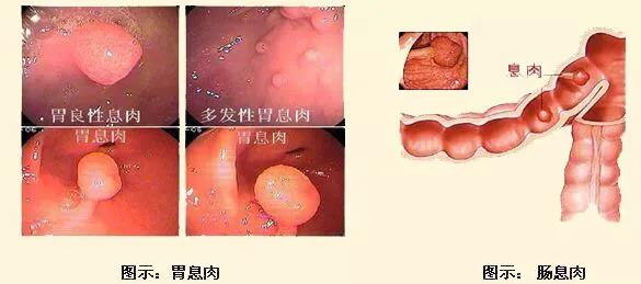 息肉癌变中晚期怎么治疗,如何确定胃肠息肉是否癌变