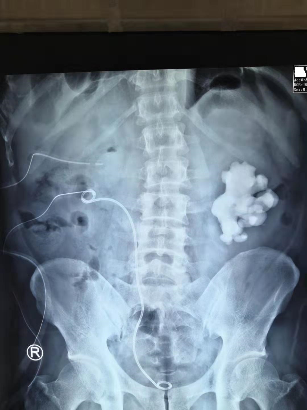 疯狂的石头碎石,疯狂的石头包世宏结石