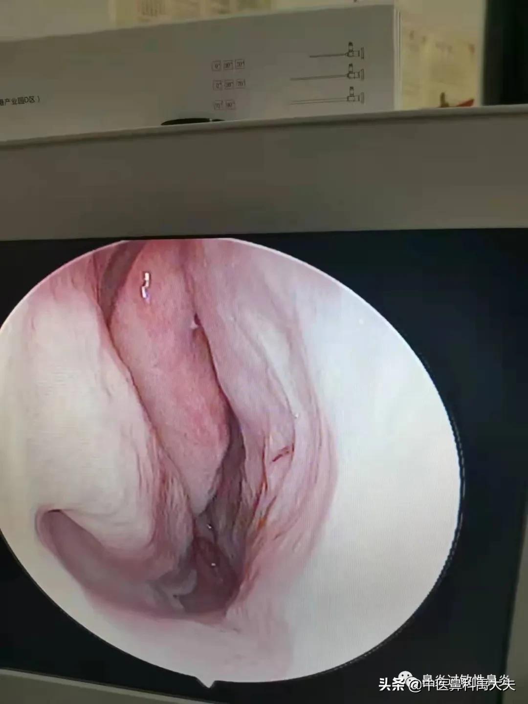 血管运动性鼻炎和过敏性鼻炎症状,鼻炎和过敏性鼻炎症状区别