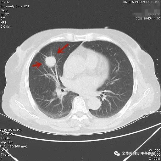 叶建明谈实性结节,叶建明肺实性良性结节会变癌症吗