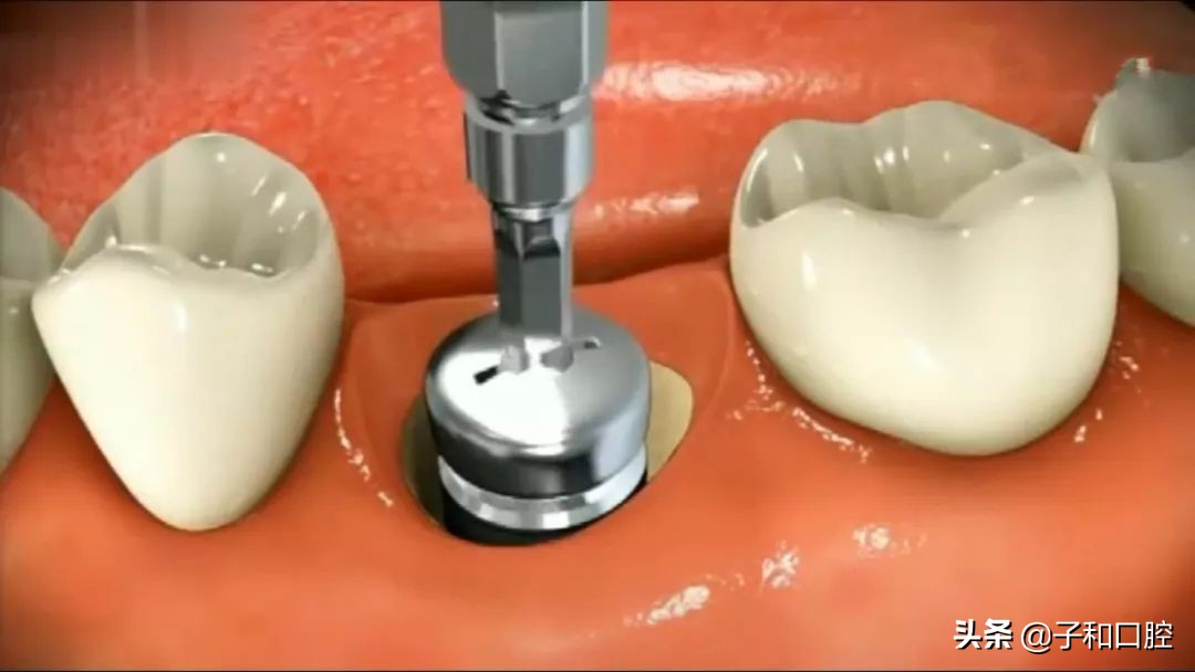 30秒看懂种植牙的全过程北大口腔,30秒看懂种植牙的全过程