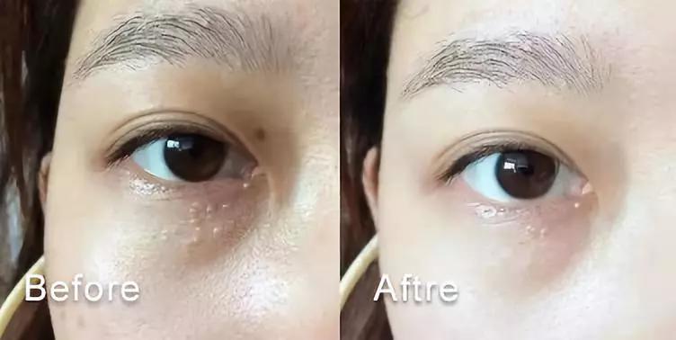 脂肪粒别用针挑教你一个土办法,脂肪粒怎么用针挑出来不疼