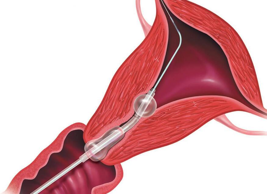 精卵结合后，为什么要在输卵管待好几天？几个原因让着床更踏实