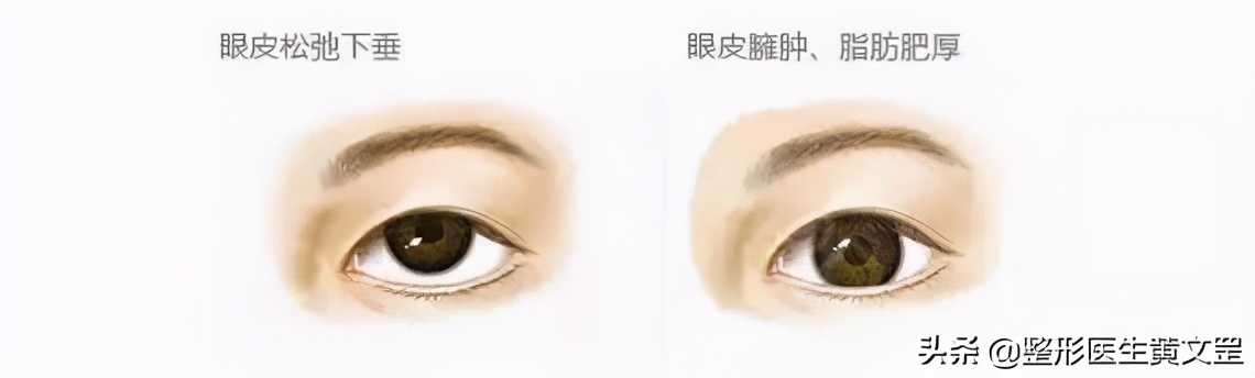 黑眼珠一定是圆吗,黑眼珠全部露出来眼睛大吗