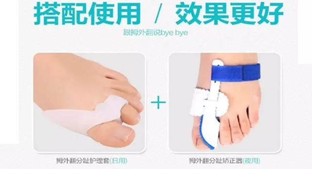 什么叫做拇外翻,什么是拇骨外翻