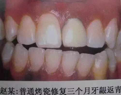 换一副烤瓷牙什么材料比较好,各类烤瓷牙材料的优缺点对比