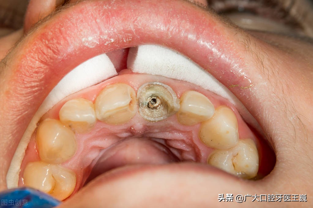 医生建议不拔牙而补牙的好处,牙齿坏得严重建议拔牙还是补牙