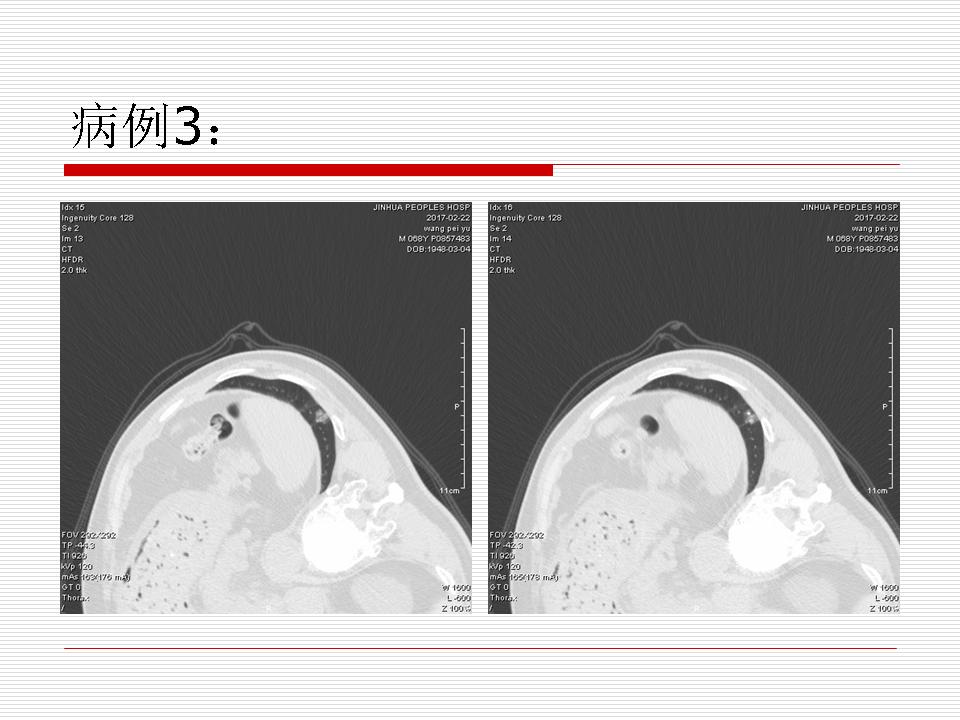 像炎症的肺癌能治好吗,医生说可能是肺癌也可能是炎症