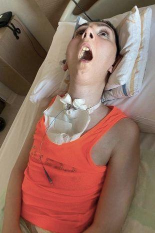 抽脂减肥成了植物人,整形抽脂死亡