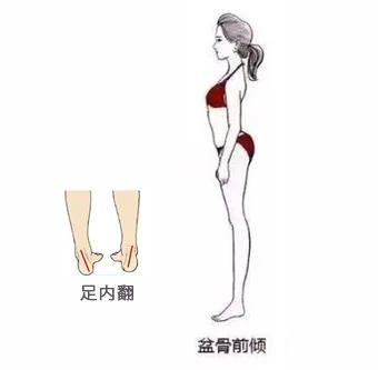 矫正腿型应该找谁,xo型腿矫正最快变直的方法视频