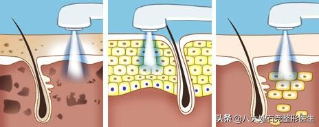 光子嫩肤会让皮肤变薄吗,长期光子嫩肤皮肤会变薄吗