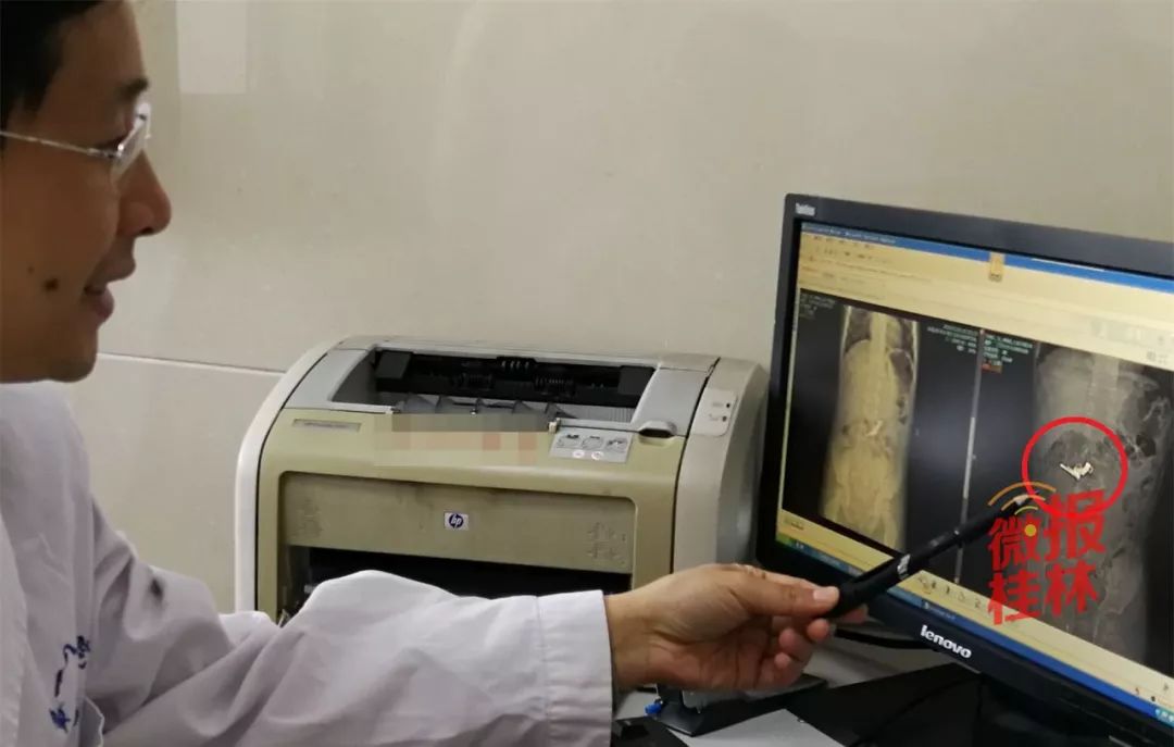 小孩误吃玩具枪,儿童误吞玩具枪软弹