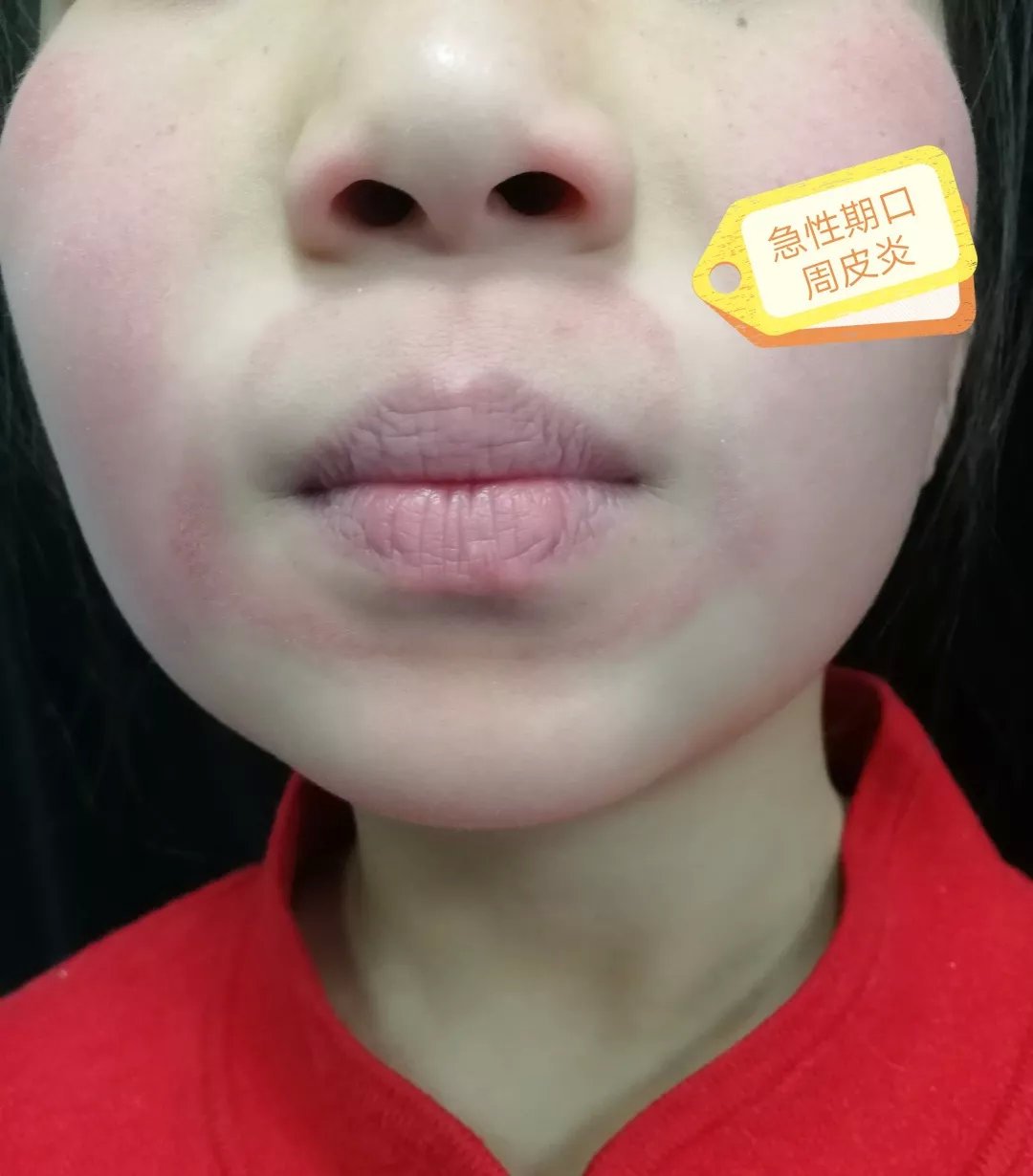 孩子咳嗽嘴角烂怎么办,我家小孩嘴烂了半夜睡觉还哭