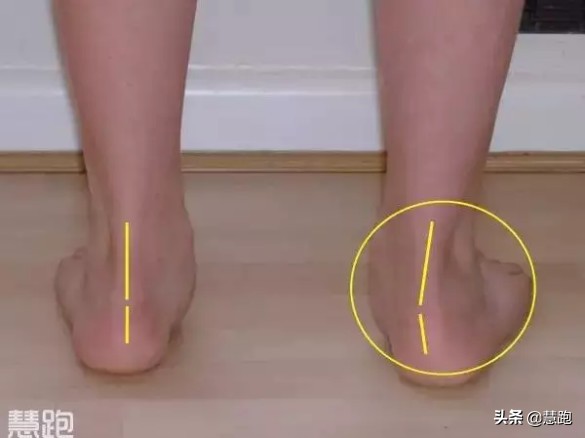 治疗足底筋膜炎最好的方法,足底筋膜炎治疗的正确方法