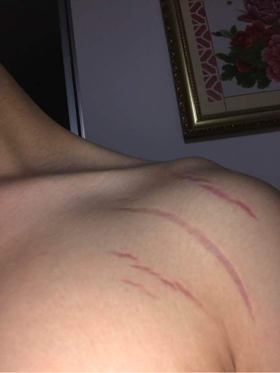 健身后肌肉上有红色纹路,健身后有条纹怎么回事