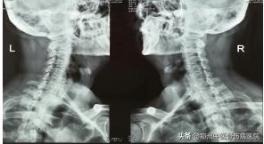 李氏砭法刮痧培训班在我院举办,铜砭虎符耳部刮痧手法视频教学