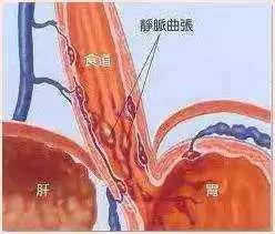 要命的胃出血，一旦出现，怎么办？