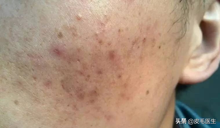 雀斑黄褐斑老年斑祛斑方法,褐斑老年斑怎么治疗效果最好