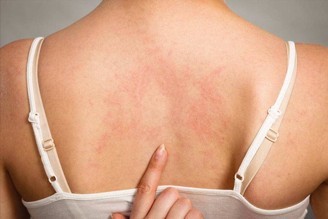 夏季荨麻疹高发期如何应对,麻疹最快的解决方法