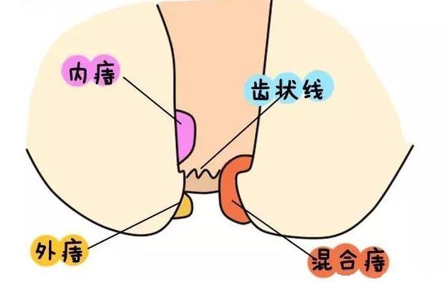 出现痔疮初期症状该如何治疗,痔疮症状治疗及注意事项