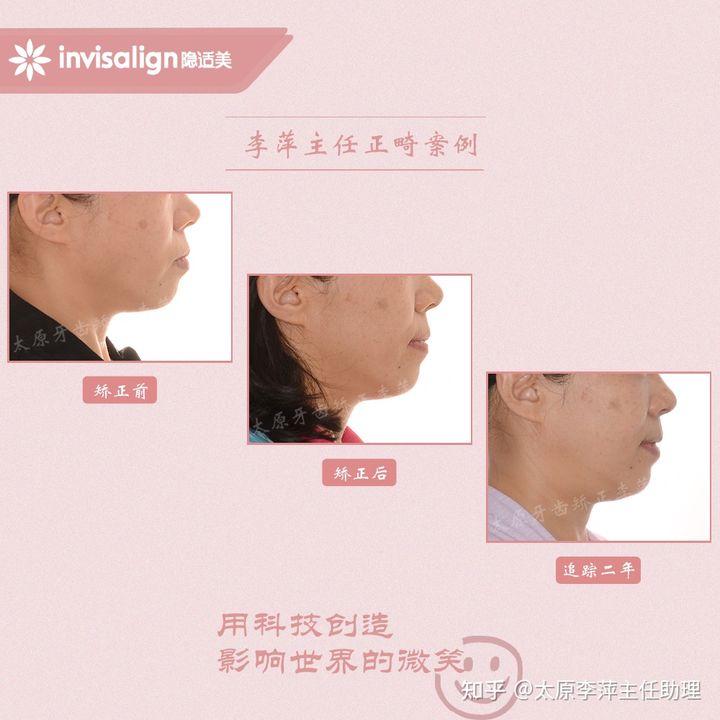 太原市牙齿正畸,太原市口腔正畸